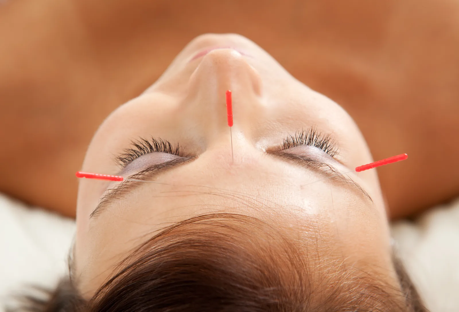 Acupuncture for Children & Teens (Ages 13–17) at Addlestone Therapy, Addlestone