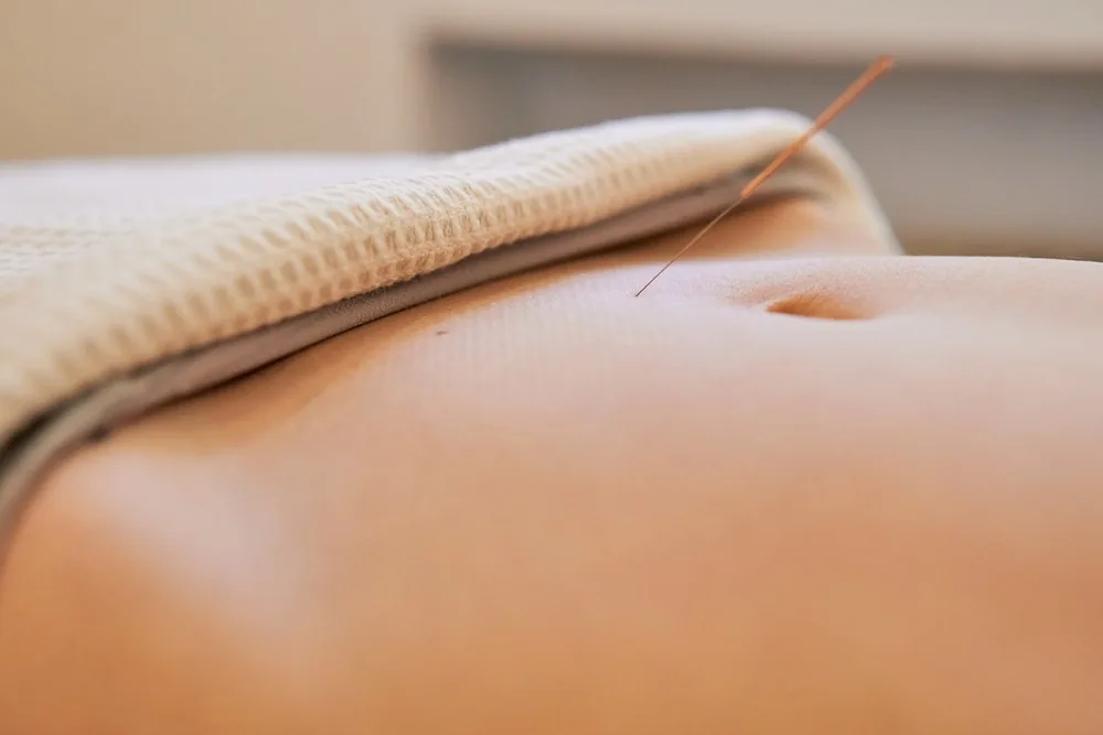 Acupuncture for Adults at Addlestone Therapy, Addlestone
