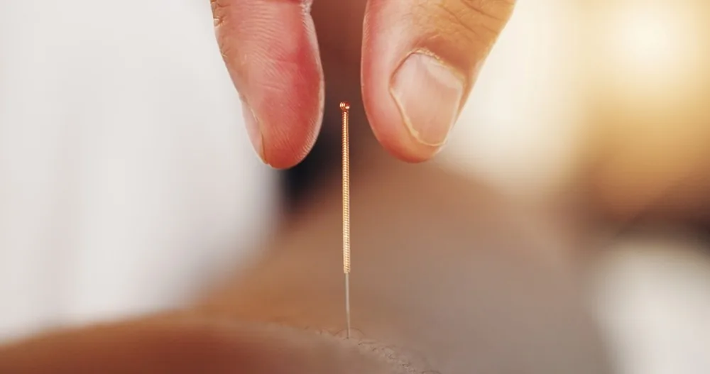 TCM (Traditional Chinese Medicine) Acupuncture at Addlestone Therapy in Addlestone, Surrey
