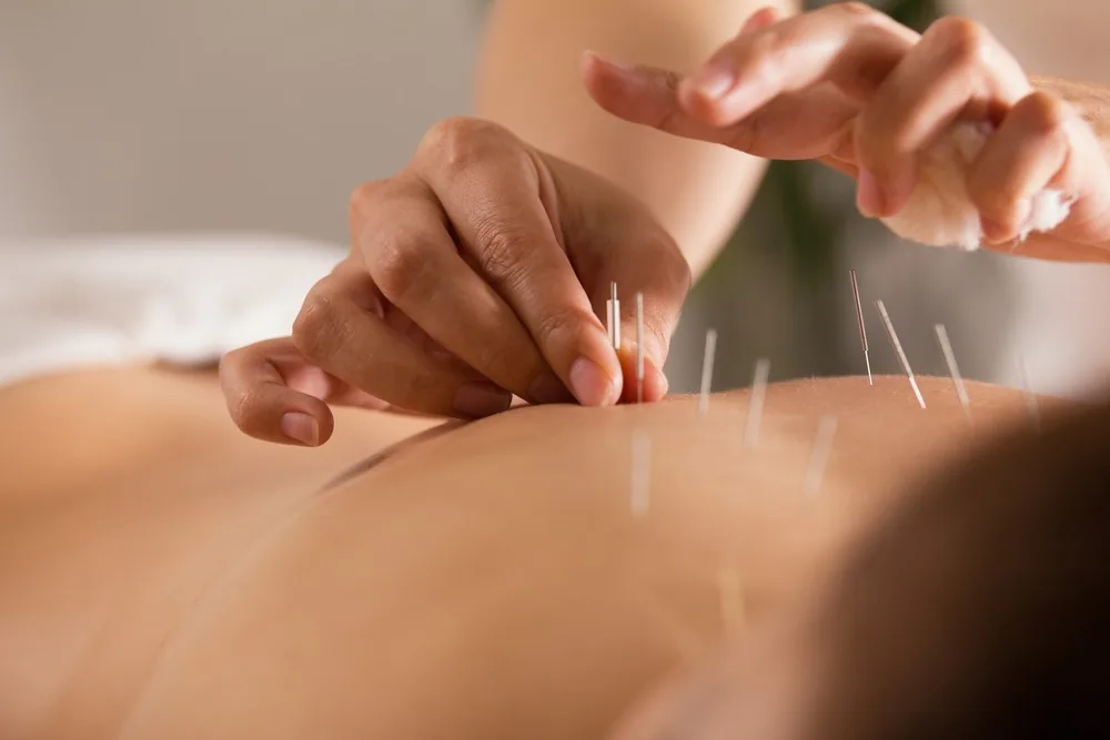 Cosmetic Acupuncture at Addlestone Therapy, Addlestone