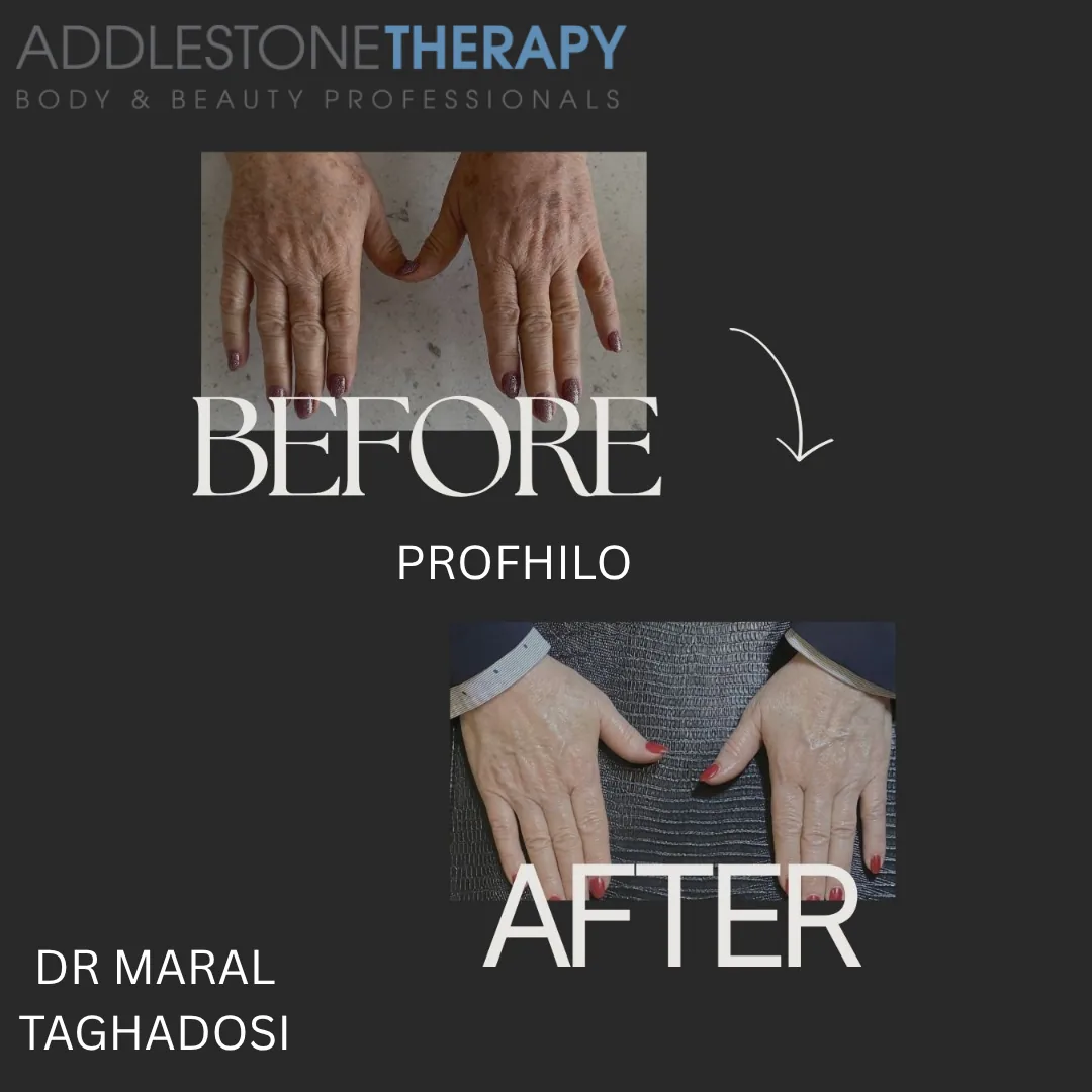 Profhilo® at Addlestone Therapy, Addlestone