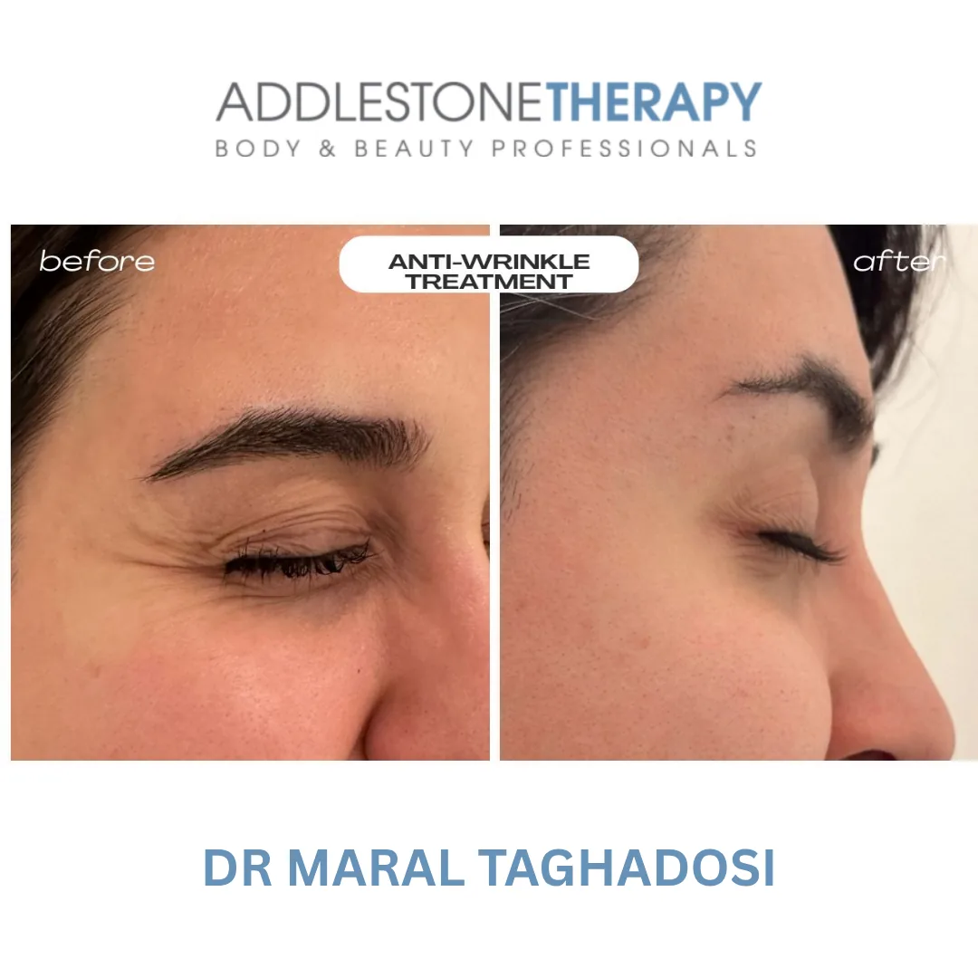 Botox at Addlestone Therapy, Addlestone