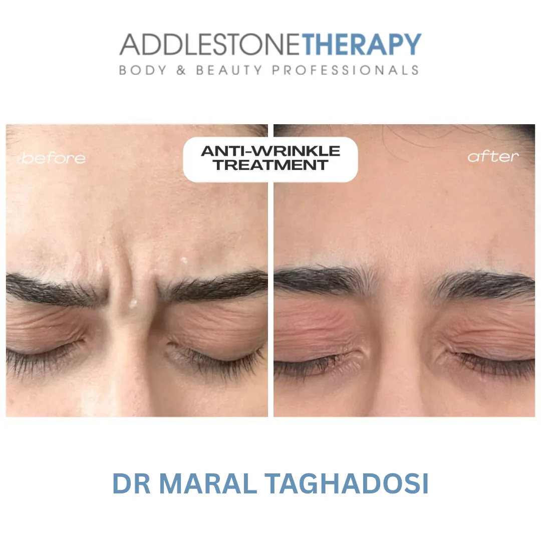 Botox at Addlestone Therapy, Addlestone